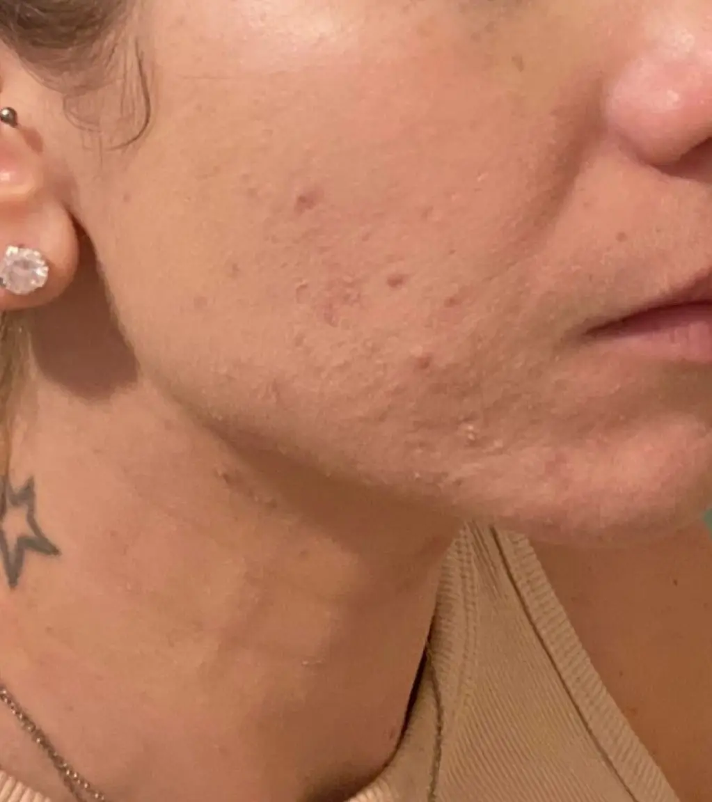 Skin after laser treatment