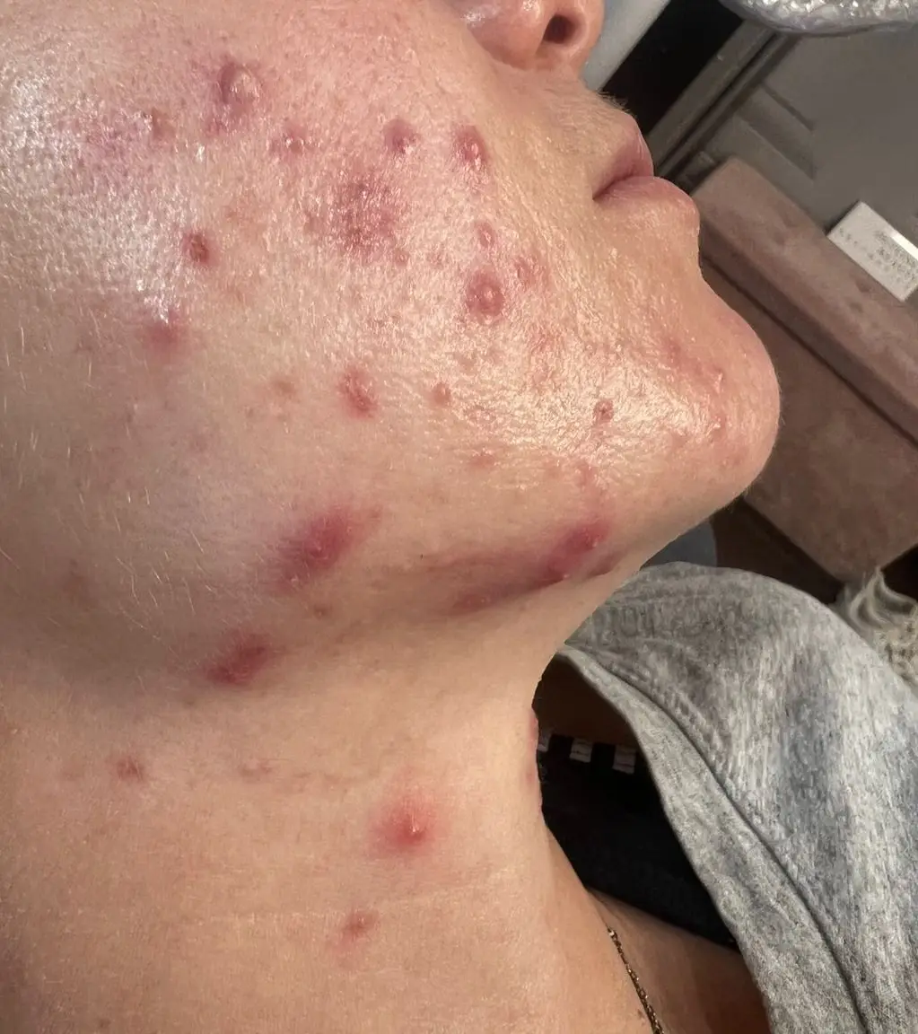 Skin before laser treatment